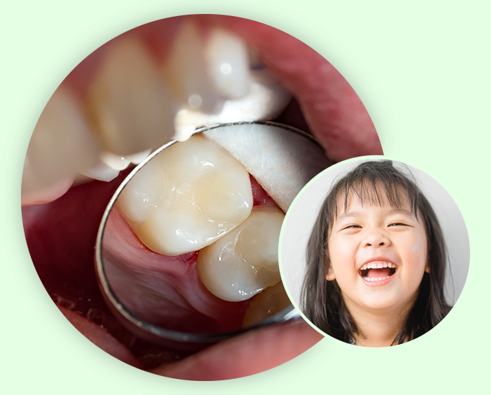 Cavity collages image Cavity collages image