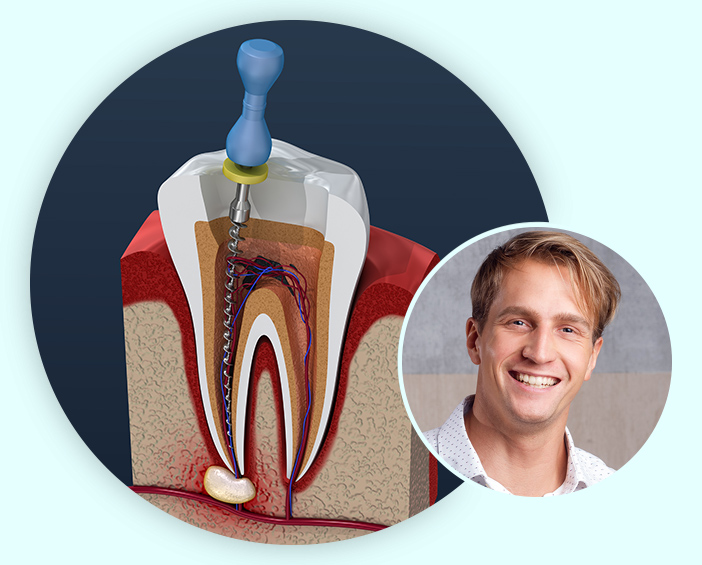 Root Canal collage image Root Canal collage image